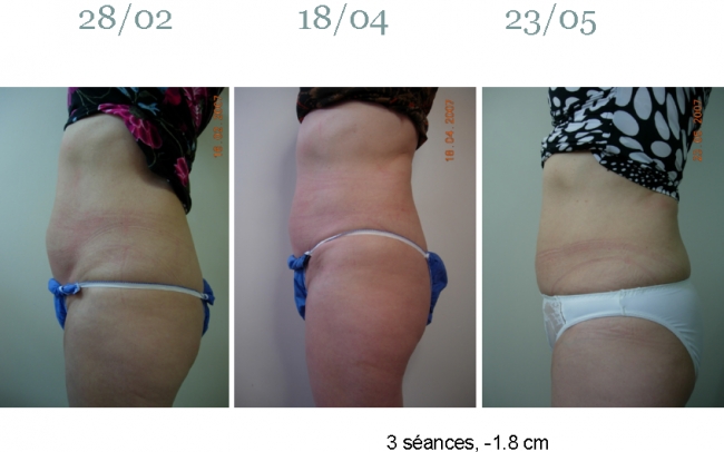 ULTRASHAPE