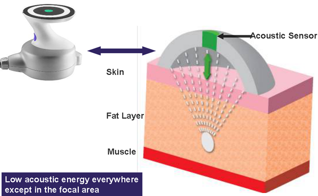 UltraShape® Pulsed Focused Ultrasound (PFU)
