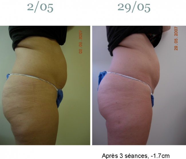 ULTRASHAPE