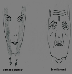Vieillissement musculo-aponévrotique